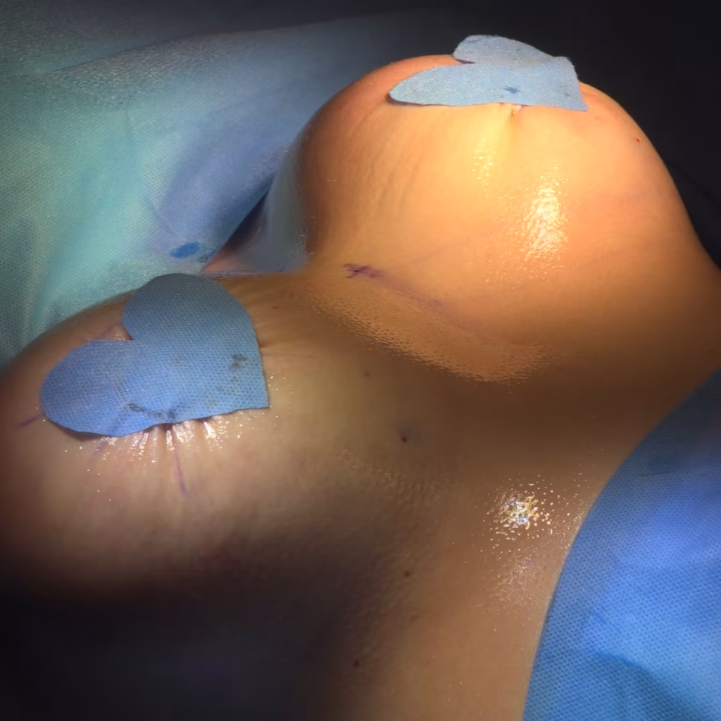 Cirugía Mamoplastia de Aumento